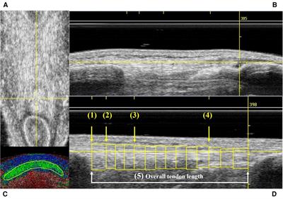 Quadriceps strength, patellar tendon quality, relative load exposure, and knee symptoms in male athletes before the anterior cruciate ligament reconstruction